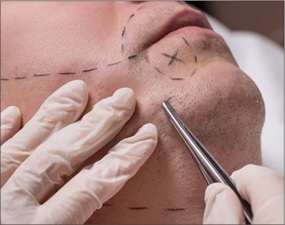 Med Esthetiks_Techniques Used in Beard Transplant_16