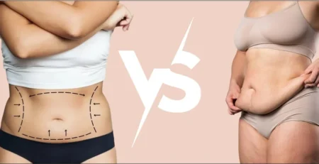 Liposuction vs Tummy Tuck