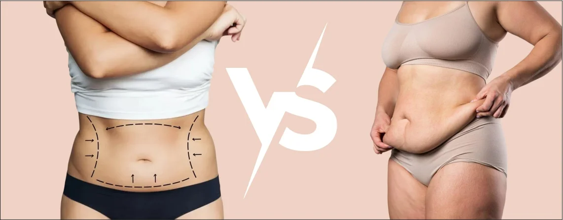 Liposuction vs Tummy Tuck