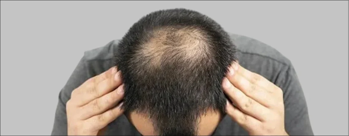 Hair Transplant Myths