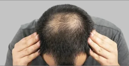 Hair Transplant Myths