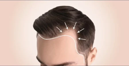 Hair Transplant for Receding Hairline
