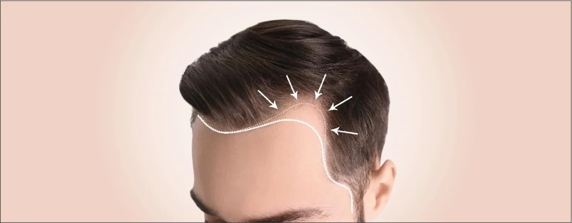Hair Transplant for Receding Hairline