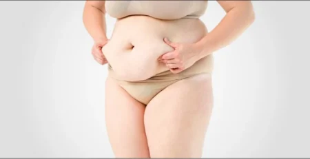 Tummy Tuck After Pregnancy