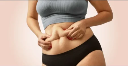 tummy tuck for Diastasis Rect