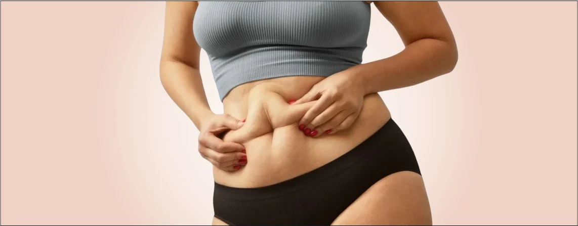 tummy tuck for Diastasis Rect