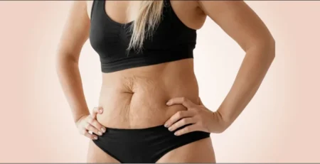 Tummy Tuck After Weight Loss