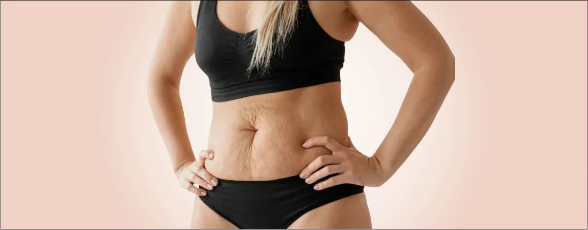 Tummy Tuck After Weight Loss