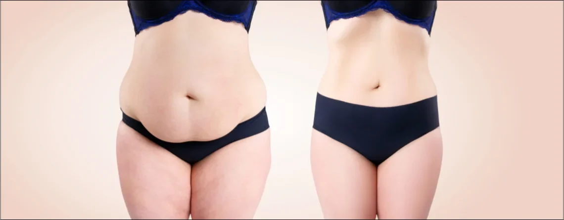 Liposuction Recovery