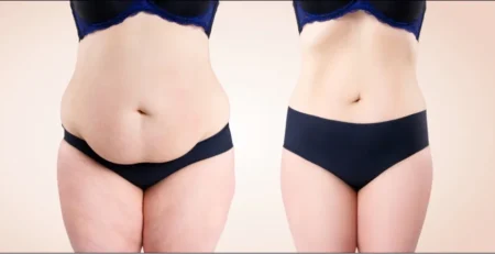 Liposuction Recovery